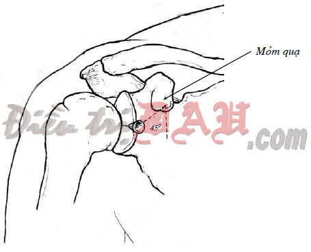 Glenohumeral Joint Injection