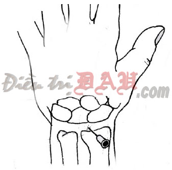 Wrist Joint Injection