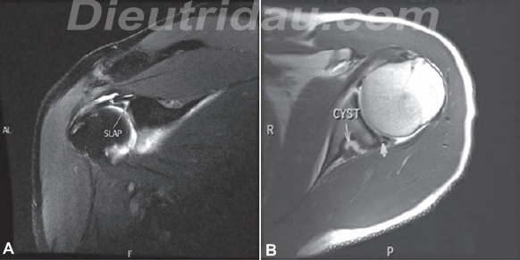 Shouder Instability and Disruption of the Antetior Capsular