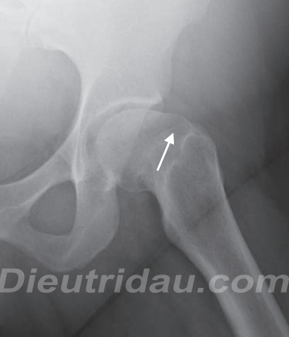 Femoroacetabular Impingement of the Hip