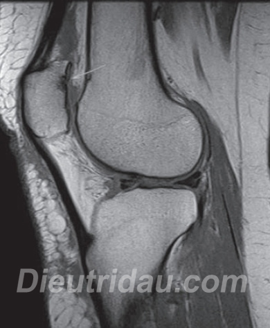 Other Knee Abnormalities