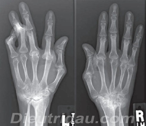 Rheumatoid Arthritis Imaging