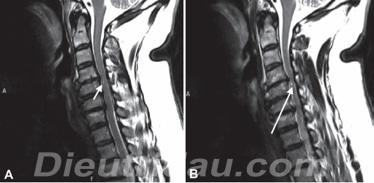 Cervical Spinal Stenosis and Foraminal Stenosis