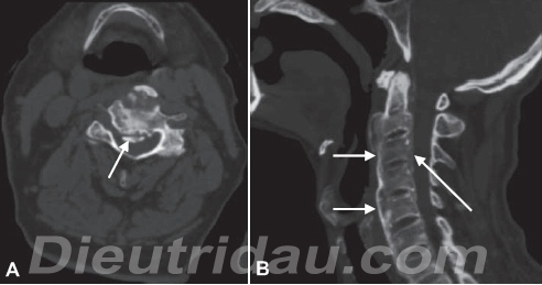 Cervical Spinal Stenosis and Foraminal Stenosis