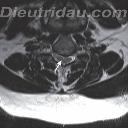 Lumbar Disc Herniation