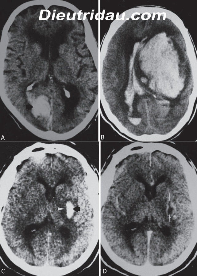 Hemorrhagic Stroke Imaging