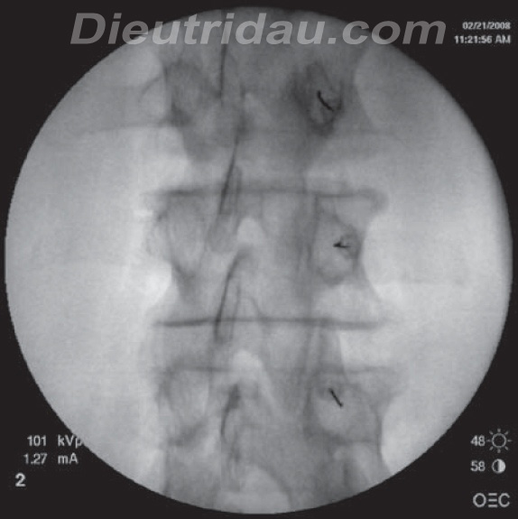 Zygapophyseal Joint Injection