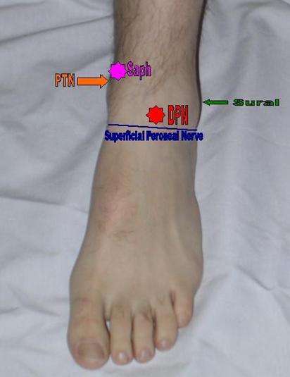 Superficial Peroneal Nerve Block