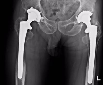 Metal Hip Replacements: Toxic Effects?